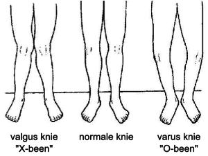 Valgus kniestand